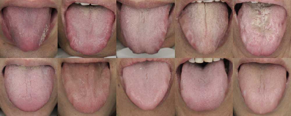 Les liens entre les maladies et la couleur de la langue